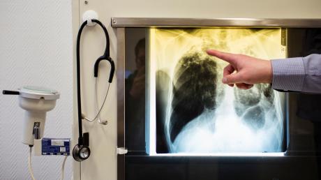 SPD-Landtagsabgeordneter Herbert Woerlein schlägt ein Gesetz vor, demzufolge Kindergarten-Praktikanten zukünftig vorsorglich auf Tuberkulose untersucht werden sollen.