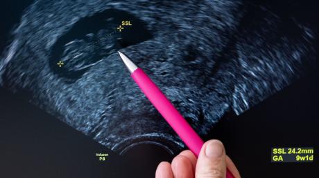 Der Kopf eines Fötus auf einem Ultraschallbild. Die Scheitel-Steiß-Länge (SSL) deutet auf eine Schwangerschaftsdauer von etwa neun Wochen hin.