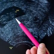 Der Kopf eines Fötus auf einem Ultraschallbild. Die Scheitel-Steiß-Länge (SSL) deutet auf eine Schwangerschaftsdauer von etwa neun Wochen hin.