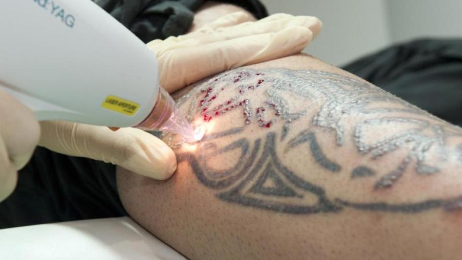 Laser-Tattooentfernung: Sử dụng công nghệ laser hiện đại, quá trình gỡ xăm đã trở nên đơn giản và an toàn hơn bao giờ hết. Bạn sẽ không còn phải lo lắng về những hình xăm cũ kỹ không còn phù hợp với phong cách sống hiện tại của mình. Hãy tìm hiểu thêm về phương pháp Laser-Tattooentfernung để trải nghiệm kỳ công của công nghệ này.