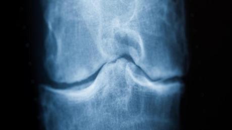 Wenn Knochen fast auf Knochen reibt: Im Verlauf einer Kniearthrose nutzt sich der Knorpel im Gelenk immer mehr ab.