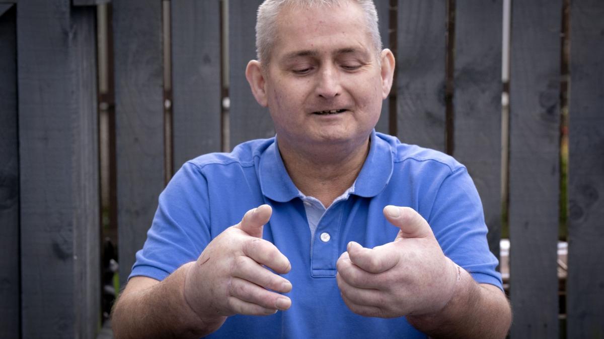 #Medizin: 12-Stunden-Transplantation: Schotte erhält zwei neue Hände