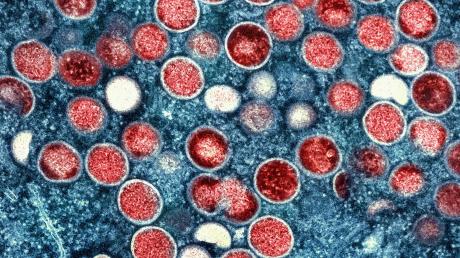 In der zentralafrikanischen Demokratischen Republik Kongo breitet sich das Mpox-Virus aus.